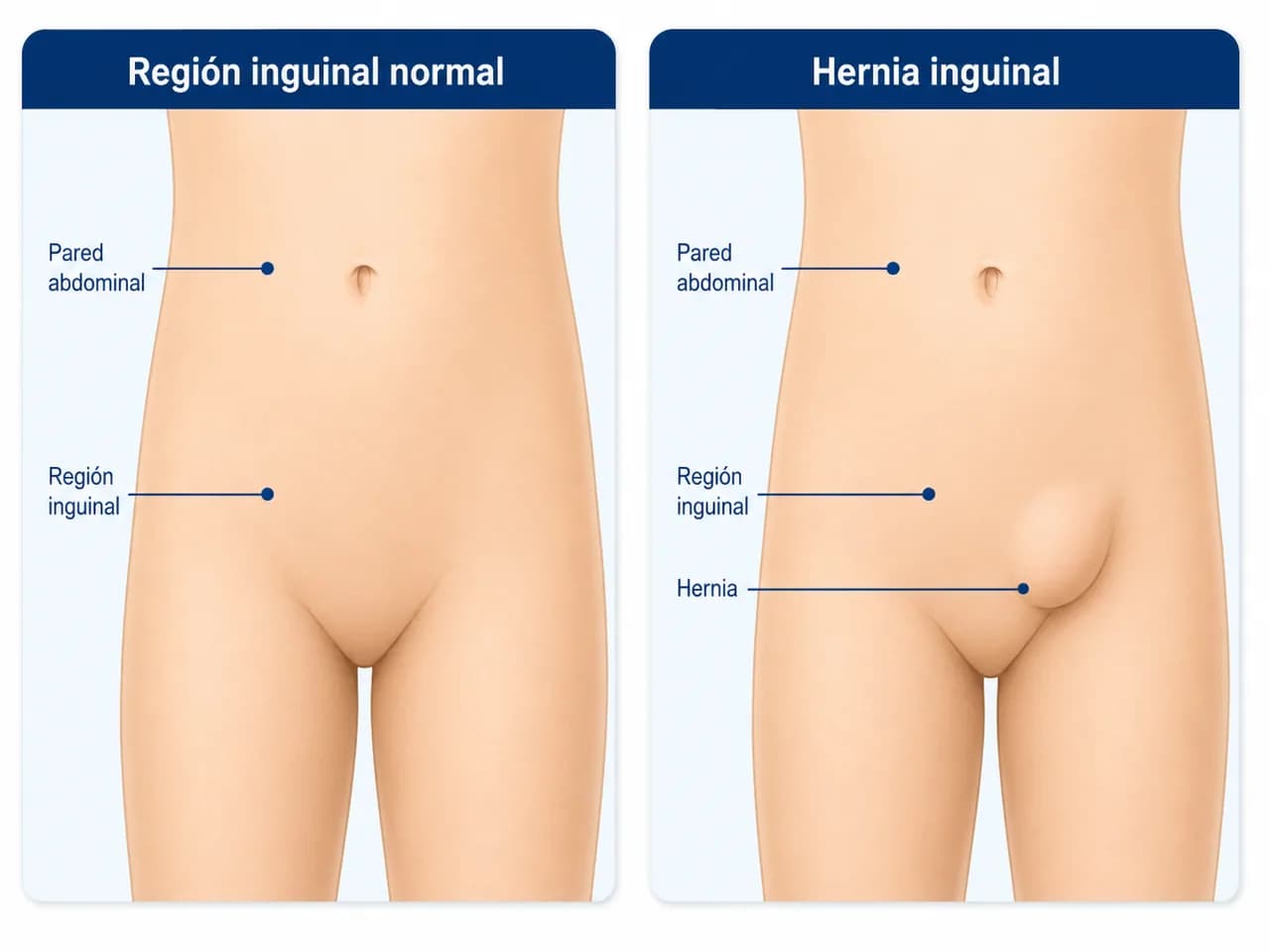 Comparación educativa de la pared inguinal sin hernia y con salida de tejido a través de un defecto