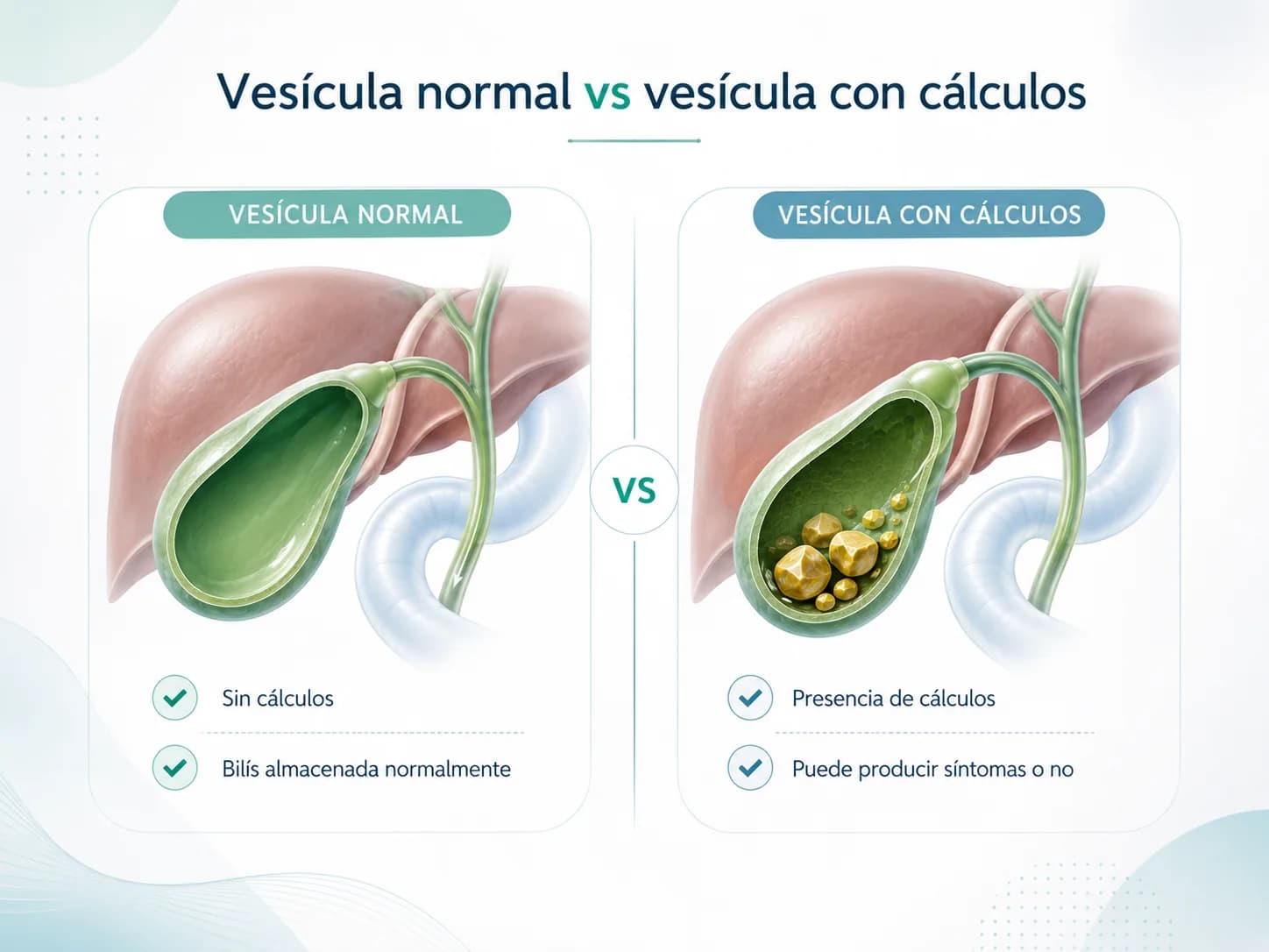 Comparación ilustrada de una vesícula sin cálculos y una con cálculos